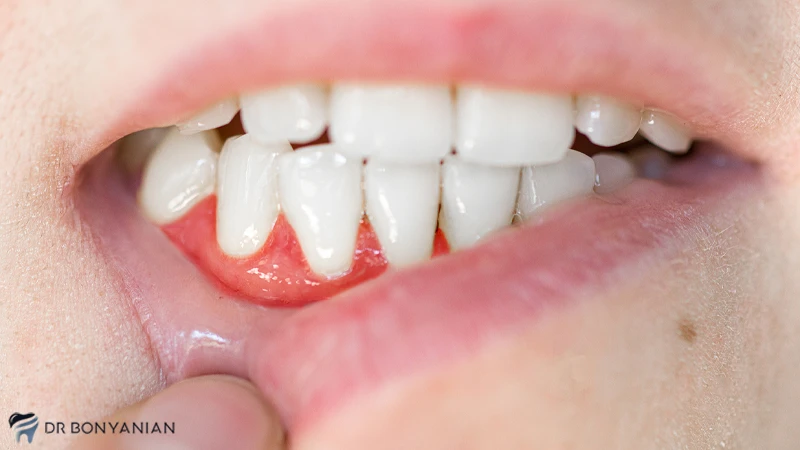 تشخیص آبسه دندان