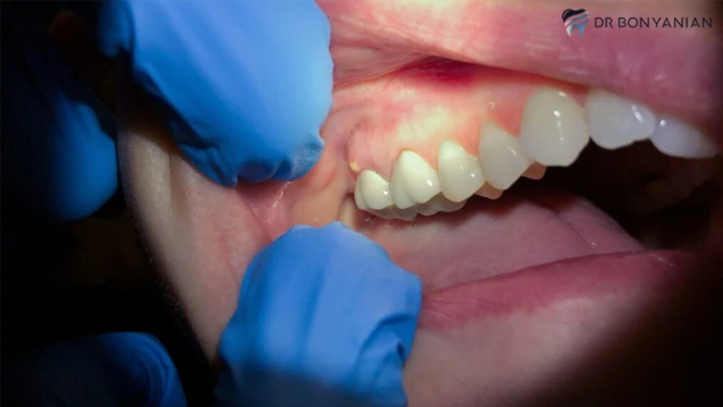 درمان فوری آبسه دندان با قرص