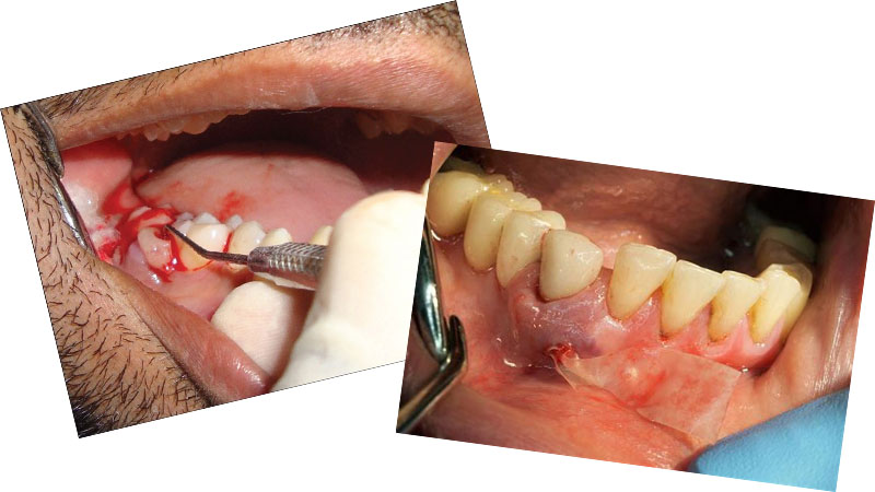جراحی برای درمان عفونت دندان