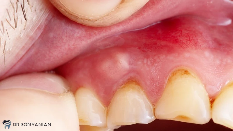 علائم آبسه دندان