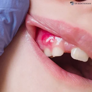 درمان ابسه دندان | دارو برای آبسه دندان | برای باز شدن آبسه دندان