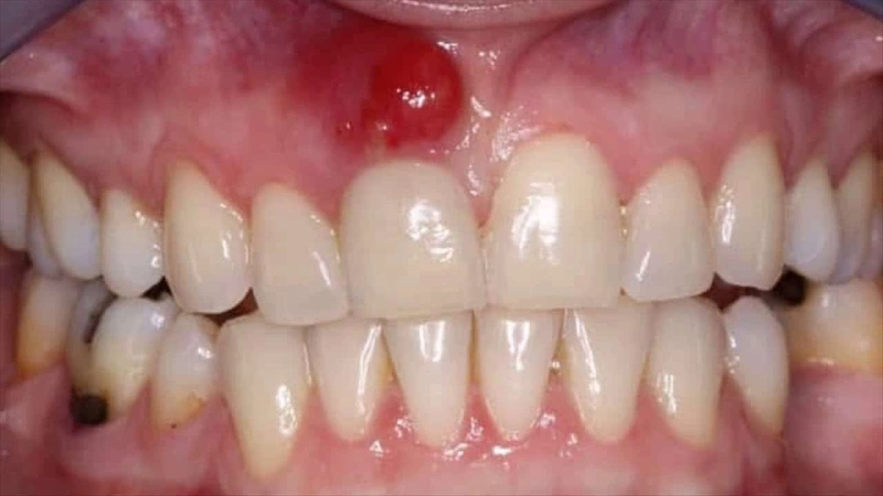 خطر عفونت دندان برای بدن