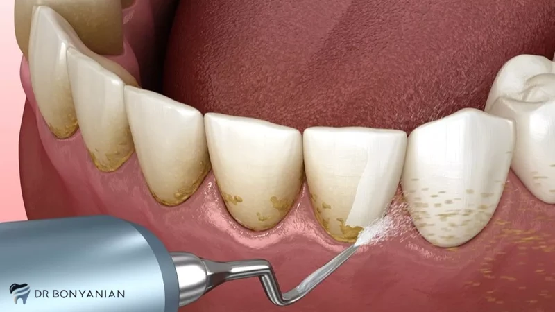 Treating toothache with scaling
