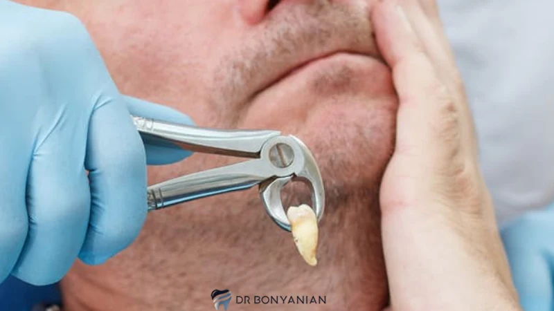 Treating pain after lower wisdom tooth extraction