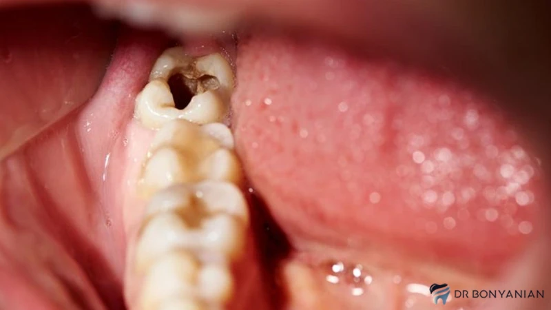 علائم و نشانه های پوسیدگی دندان