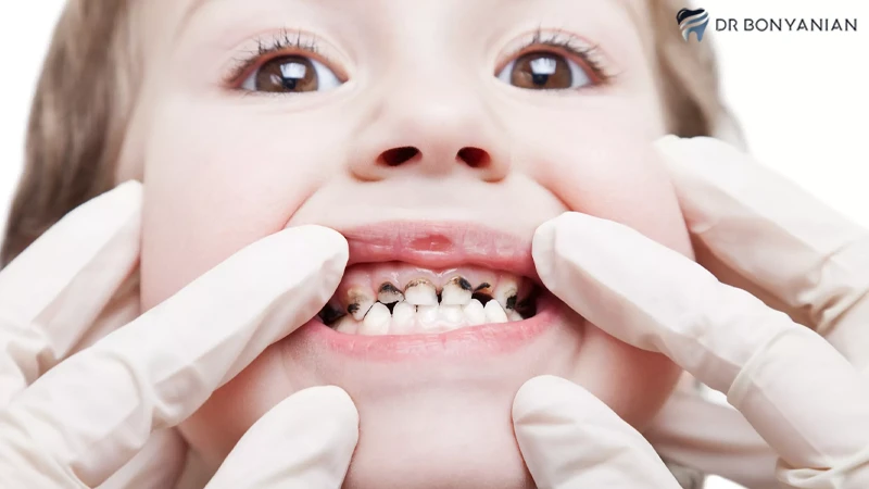 درمان پوسیدگی دندان کودک در خانه