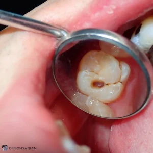 درمان پوسیدگی دندان با روش‌های خانگی