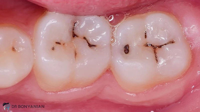 علت پوسیدگی دندان چیست