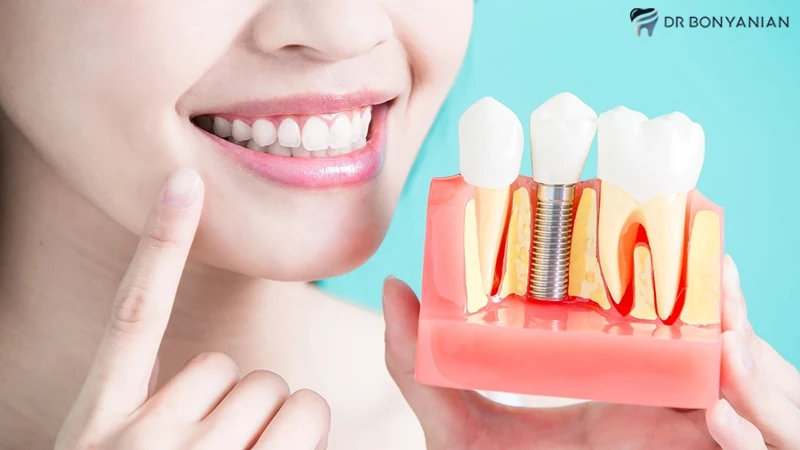مزایای ایمپلنت فوری دندان