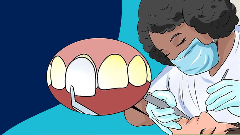تقویت مینای دندان - ونیرها را روی دندان‌های خود را بچسبانید.