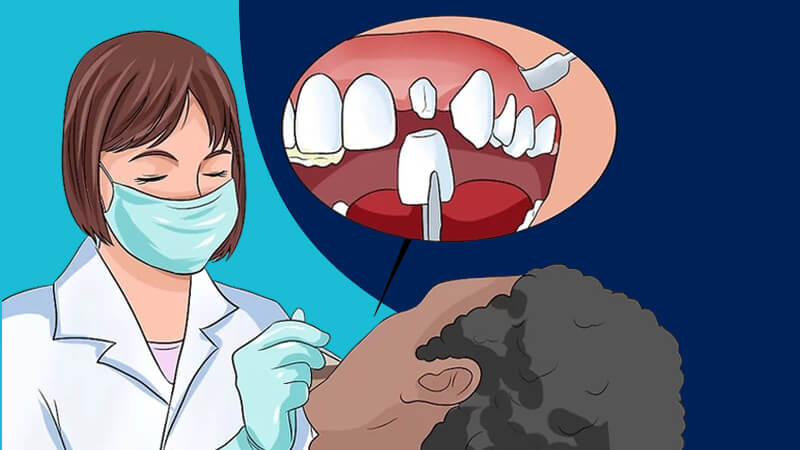 تقویت مینای دندان - در مورد گزینه‌های ترمیم با دندانپزشک مشورت کنید.
