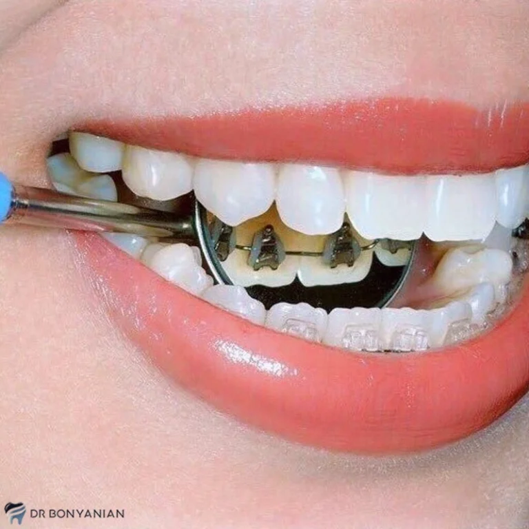 ارتودنسی لینگوال | مزایا، معایب و طول درمان
