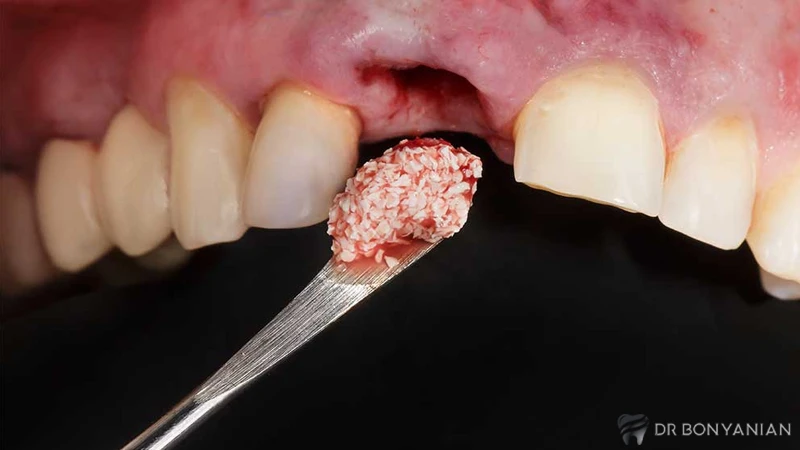جراحی پیوند استخوان دندان چیست