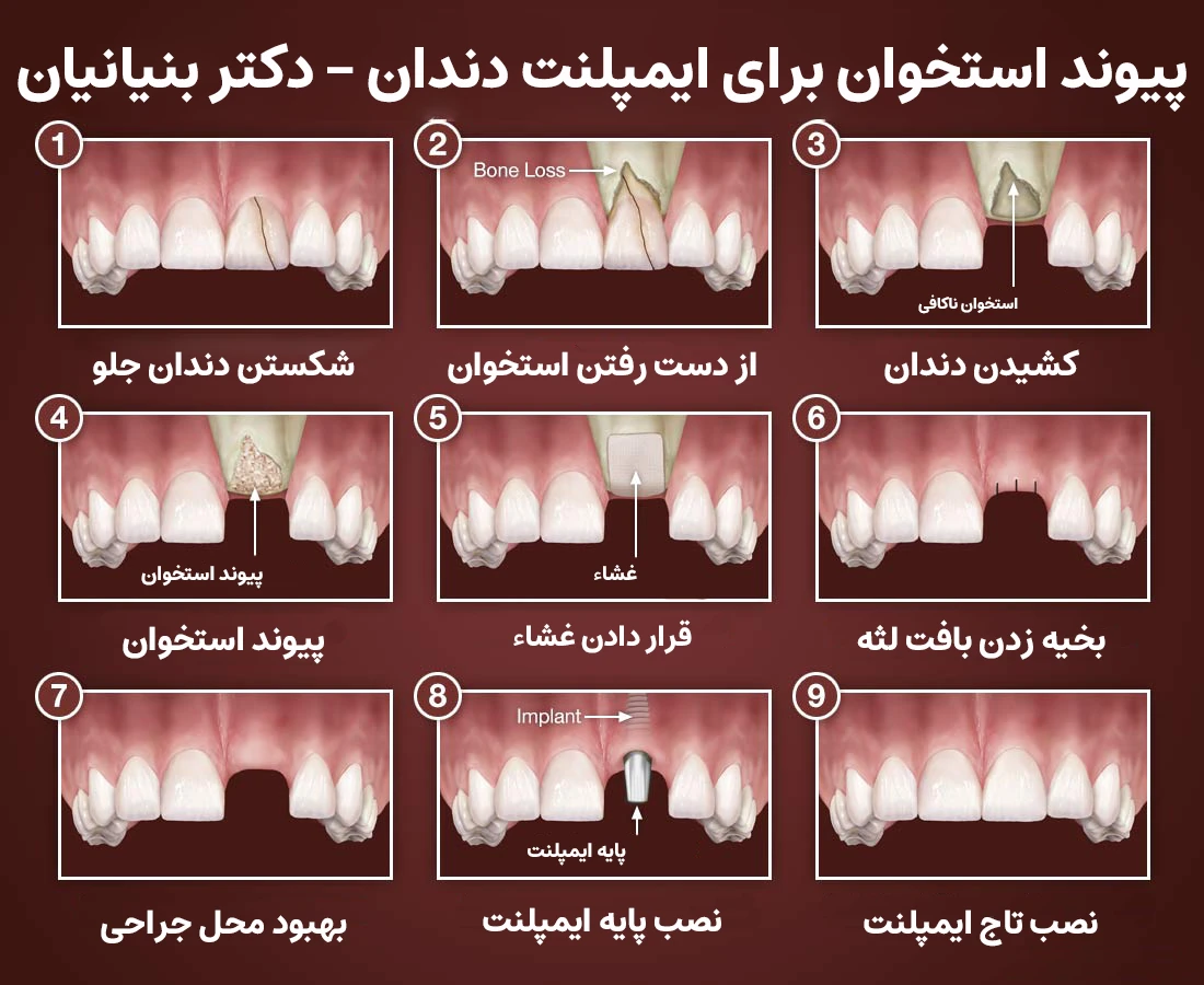 مراحل عمل پیوند استخوان دندان