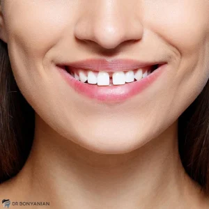 علت، انواع و درمان فاصله بین دندان ‌ها یا دیاستما