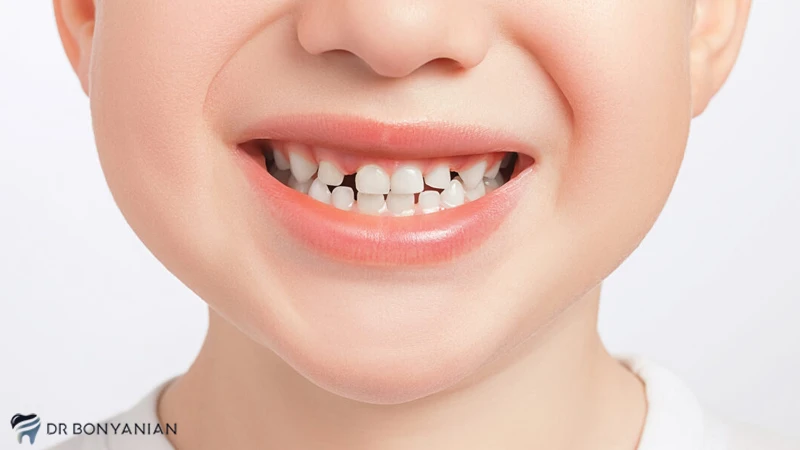 فاصله بین دندان ها یا دیاستما در کودکان