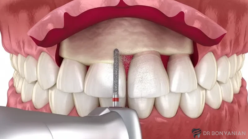 نحوه پیوند استخوان در ایمپلنت دندان