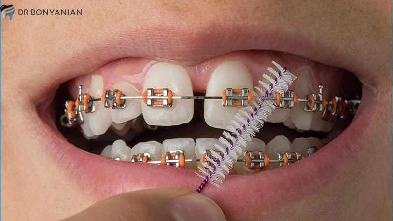 ارتودنسی برای رفع فاصله بین دندان‌ها