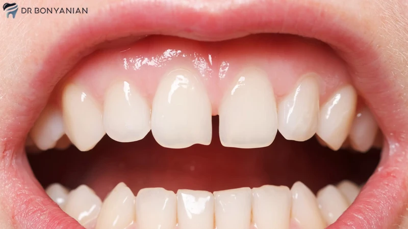 فاصله بین دندان ها چیست؟