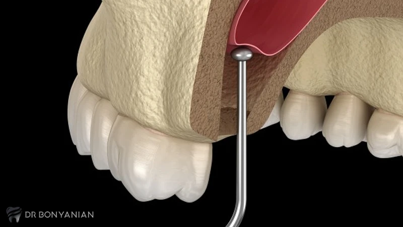 هزینه جراحی لیفت سینوس دندان