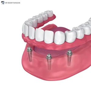 دندان مصنوعی بر پایه ایمپلنت دندان