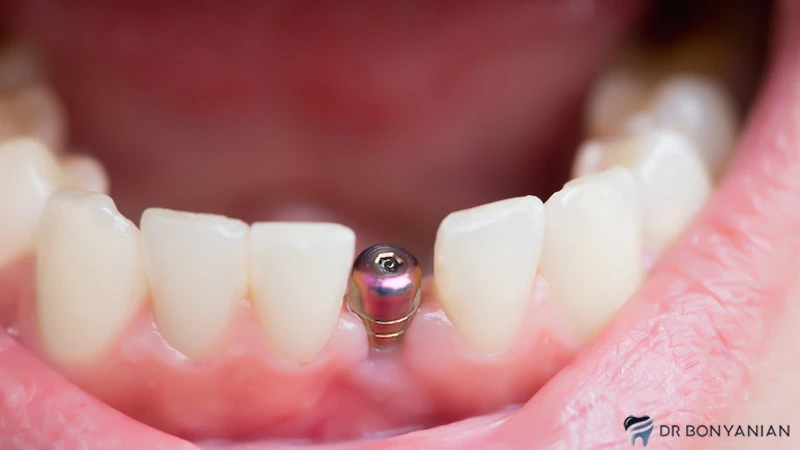علت عفونت ایمپلنت دندان