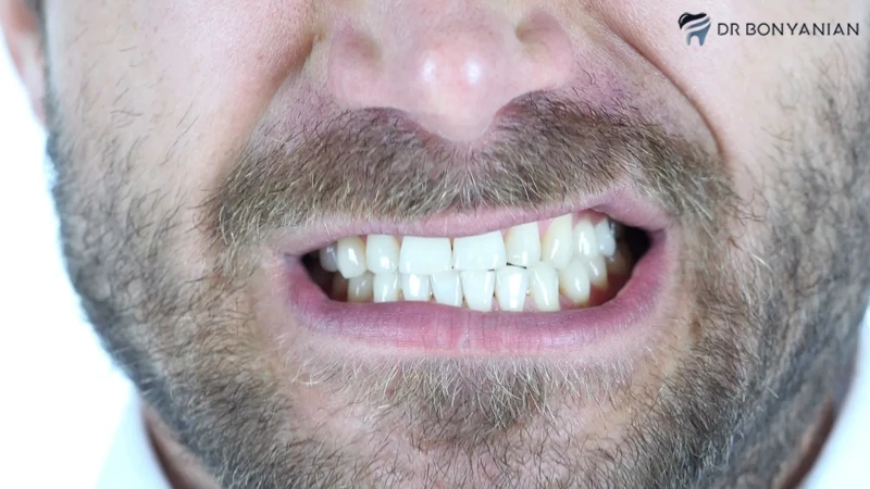 دندان قروچه و عفونت ایمپلنت دندان