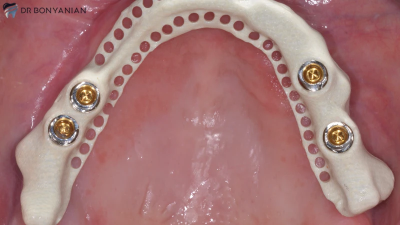 اوردنچر توپی برای کاشت دندان مصنوعی ثابت بر پایه ایمپلنت