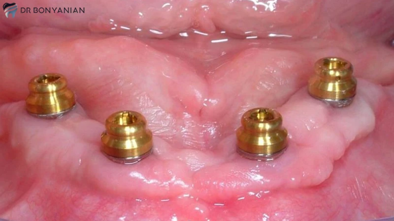 انتخاب پایه ایمپلنت برای کاشت دندان مصنوعی ثابت