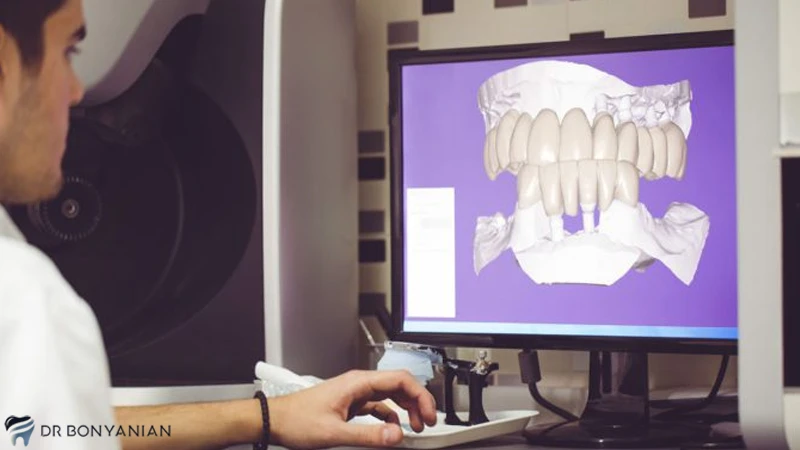 مزایای ایمپلنت دیجیتال دندان
