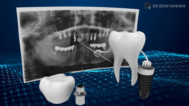 ایمپلنت دندان دیجیتالی چیست
