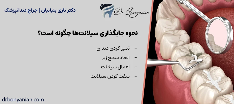 نحوه جایگذاری سیلانت‌ها چگونه است؟