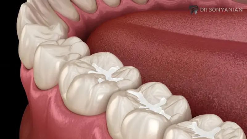 چگونه از سیلانت‌ها مراقبت کنیم؟