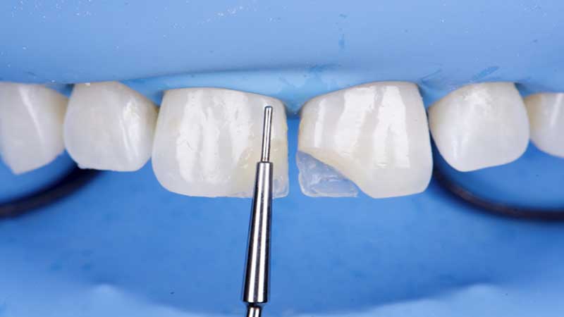 انواع کامپوزیت‌های دندانی و کاربرد آن‌ها در دندانپزشکی