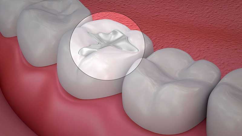 انواع ترمیم دندان با کامپوزیت