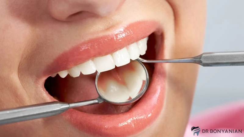 عوامل موثر بر طول عمر کامپوزیت دندان