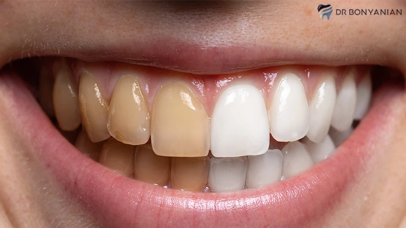 شستشوی دندان‌ها با روغن برای سفید نمودن دندان