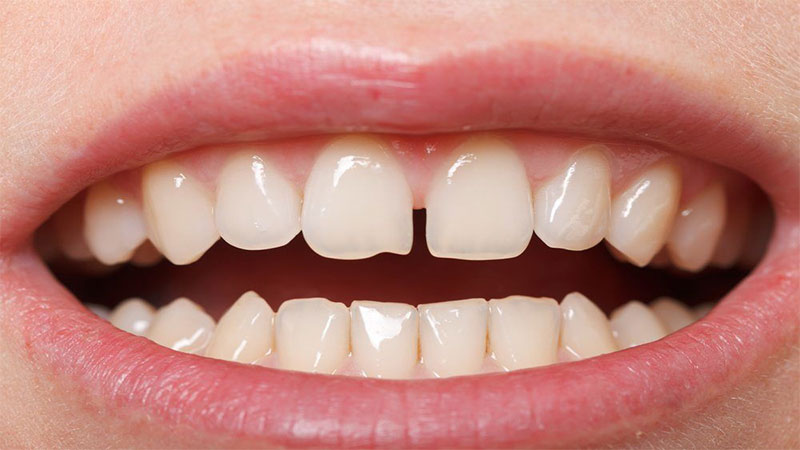 کامپوزیت دندان چیست؟ - مراحل کامپوزیت دندان