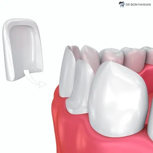 انواع لمینت سرامیکی دندان