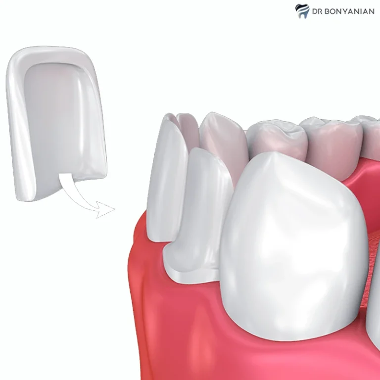 انواع لمینت سرامیکی دندان