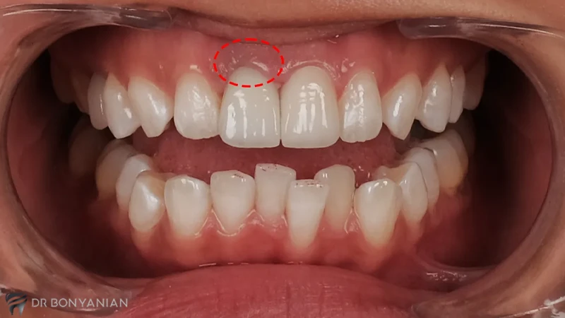 عوارض بلیچینگ دندان در خانه