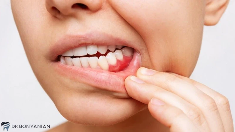 حساسیت دندان به دلیل ماده بلیچینگ