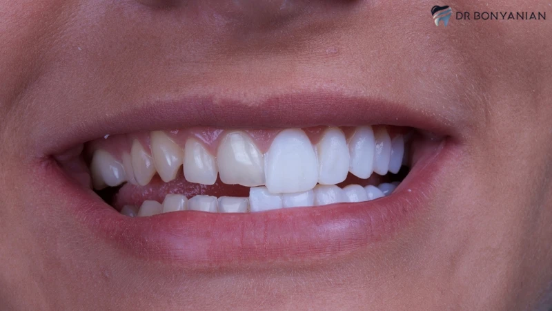 لومینیرز دندان (Lumineers) چیست؟