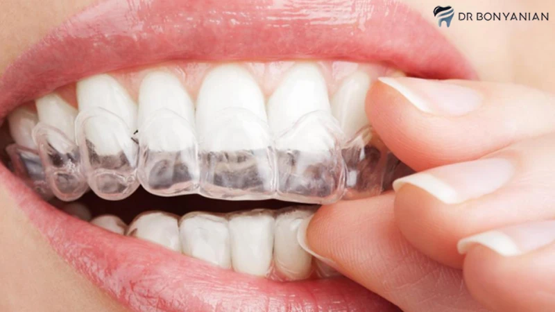 عوارض بلیچینگ خانگی دندان