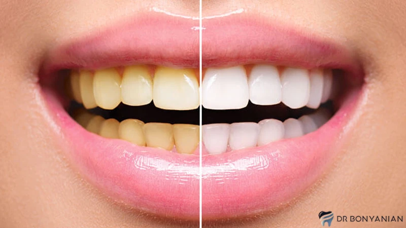 فواید بلیچینگ یا سفید کردن دندان چیست؟