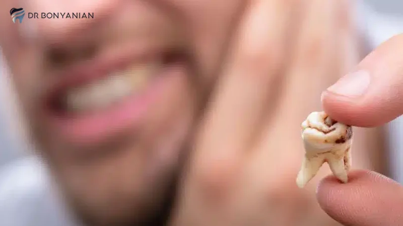 نکروز پالپ (مرگ عصب دندان)