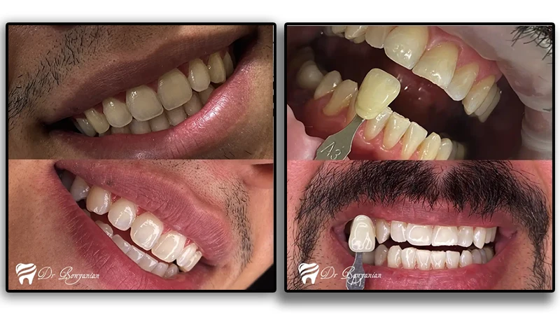 بلیچینگ بدون عوارض در کلینیک دندانپزشکی دکتر بنیانیان