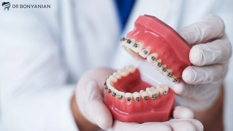 درمان دیپ بایت بزرگسالان با ارتودنسی دندان