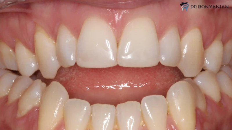 اپن بایت قدامی