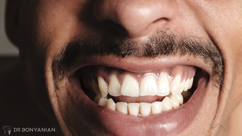 علایم ظاهری اپن بایت